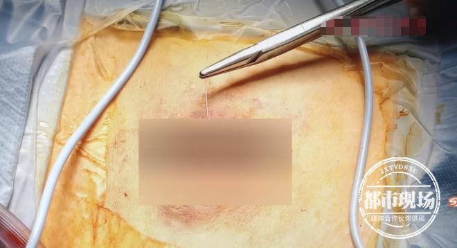 针灸毫针断体内不取出来有事吗,针灸断针取出术