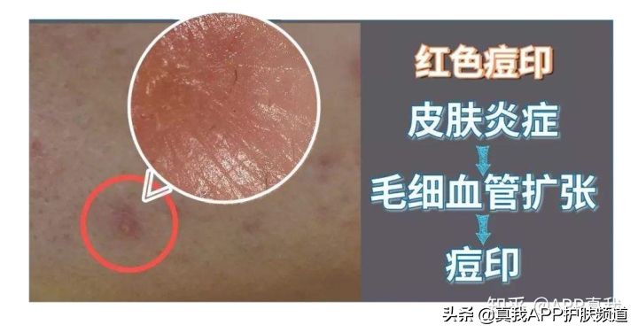 挤痘痘留下痘印多久会好,挤痘痘有哪些危害