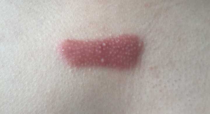 胸口上的疤痕疙瘩长大了,胸口疤痕疙瘩越长越大怎么办