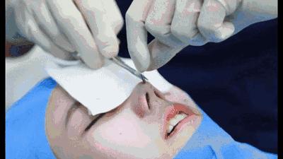 线雕隆鼻是真的吗,线雕隆鼻能维持几年还是那么挺