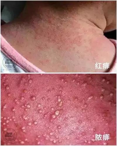 怎么区别麻疹和风疹,麻疹识别图