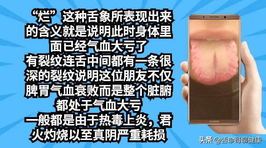 舌诊哥说亚健康,抖音舌诊哥舌象分析与感悟
