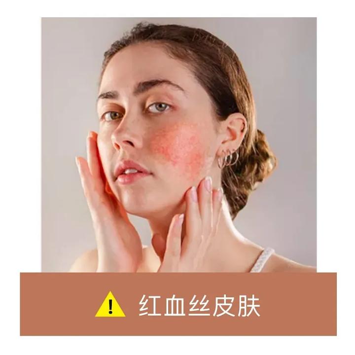 专业祛红血丝修复敏感肌,修复红血丝脸部精油