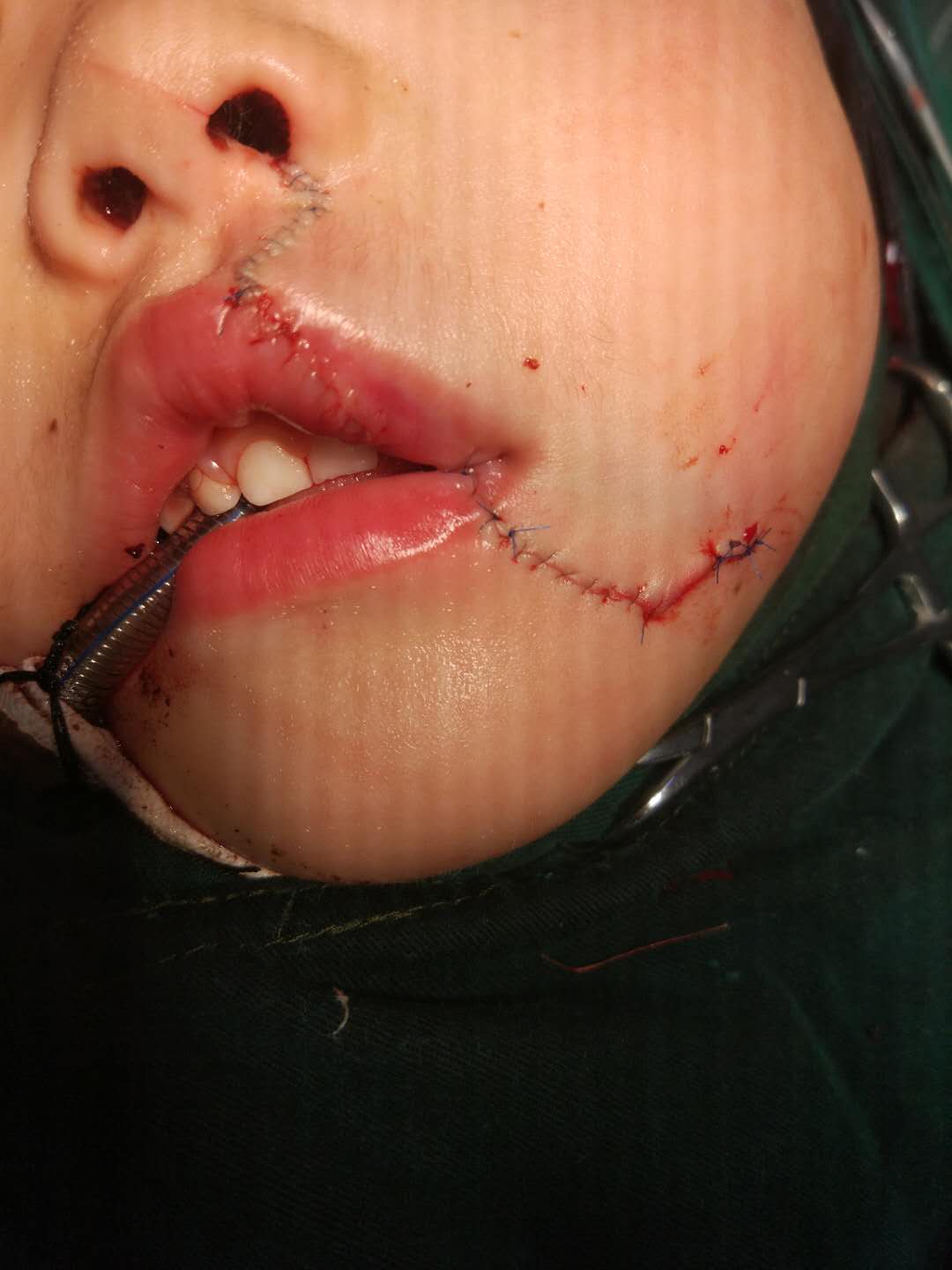 小孩子嘴巴被缝5针严重吗,孩子受伤缝针真实案例