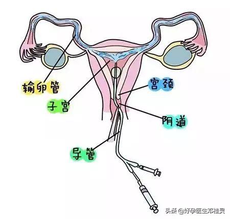 输卵管通而不畅盆腔粘连多囊卵巢,多囊加输卵管粘连可以自然受孕吗