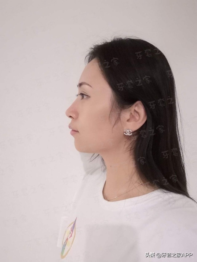 拔牙和打骨钉哪个更痛,矫正牙齿拔牙后一定要打骨钉吗