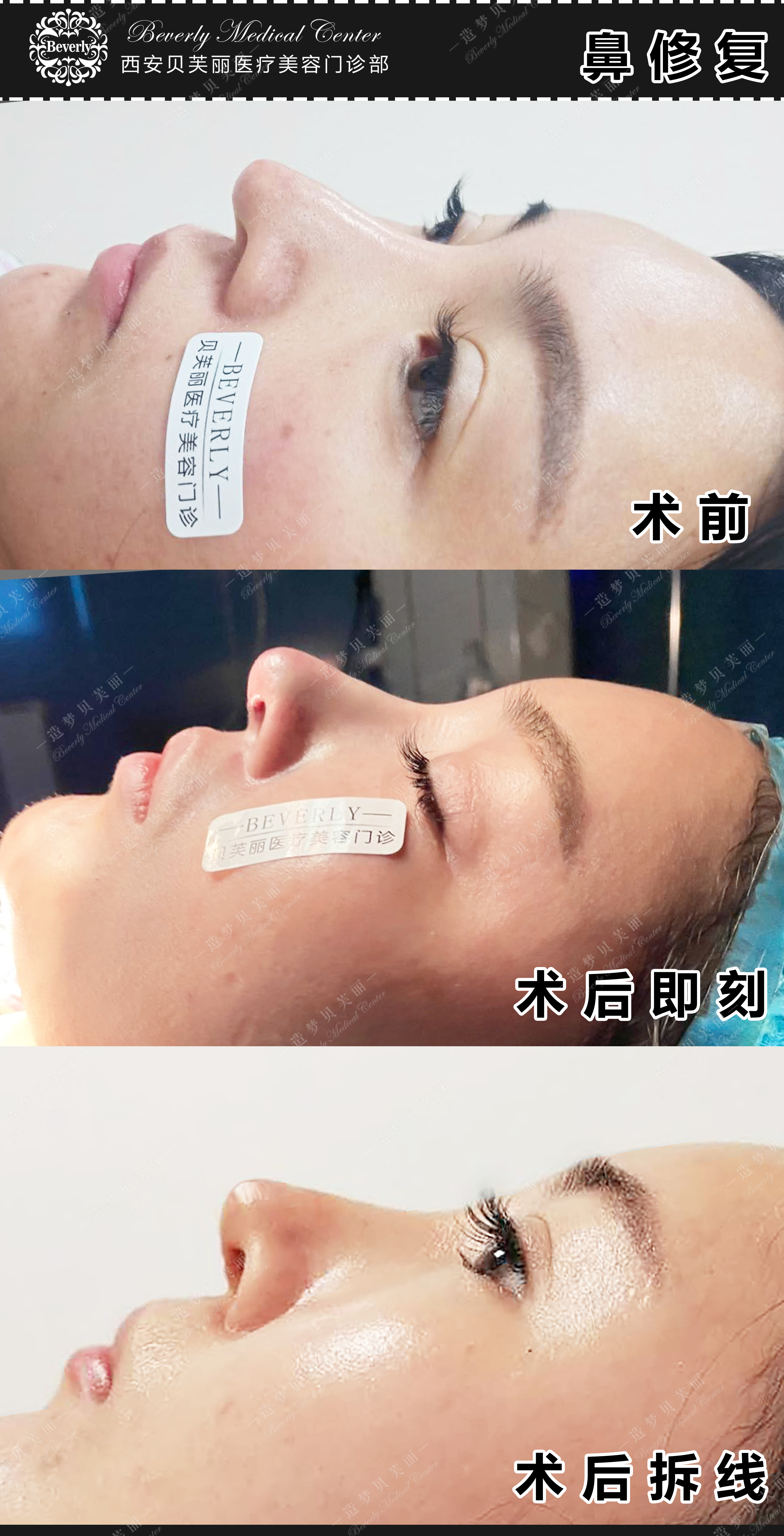 隆鼻术后一个月内可以重新修复吗,专家讲解隆鼻修复手术效果