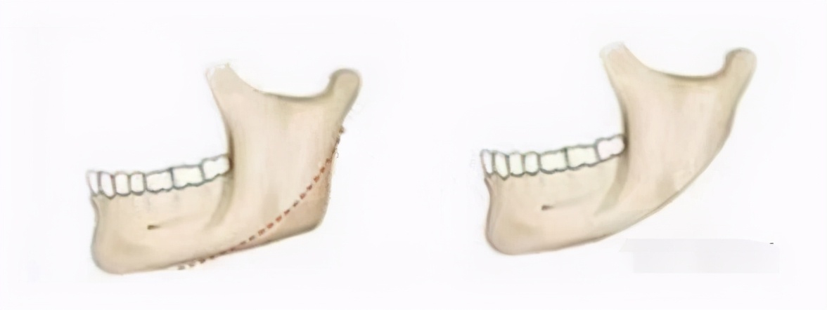 那些削骨的女明星怎么样了,哪些明星承认削骨了