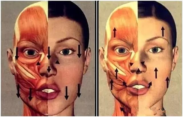 线雕和玻尿酸筋膜提升有什么区别,玻尿酸线雕是什么样子