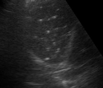 b超显示肝内多发强光考虑钙化灶,b超显示胎儿肝内钙化灶
