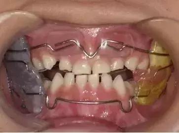 什么叫地包天怎么治疗,什么叫地包天能矫正吗