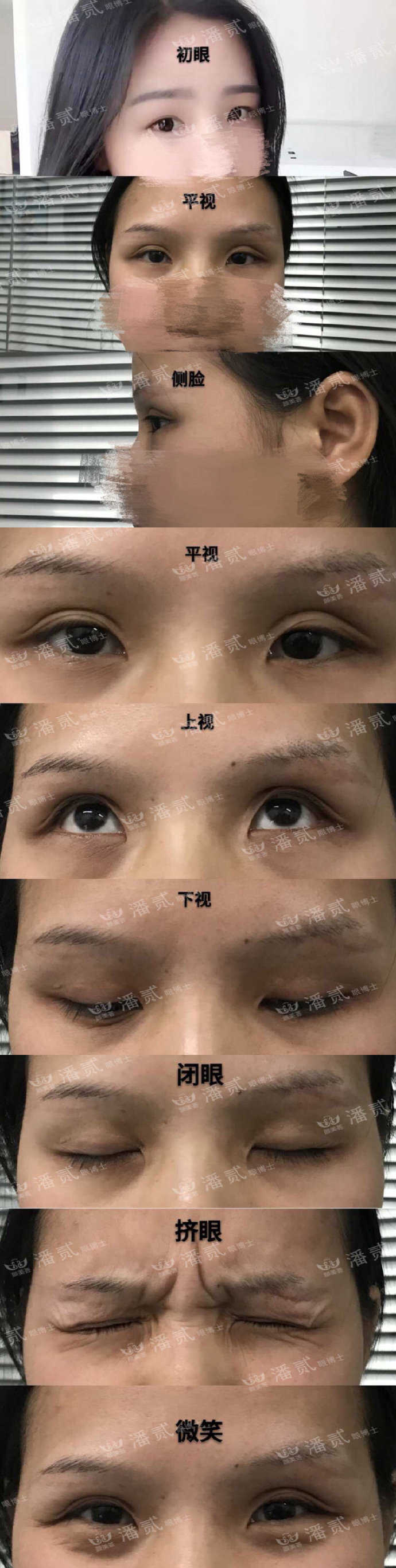 双眼皮手术后眼神凶狠是什么原因,双眼皮手术后显凶