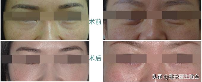 泪沟显老还是泪沟显老,泪沟填充胶原蛋白感觉不好怎么办