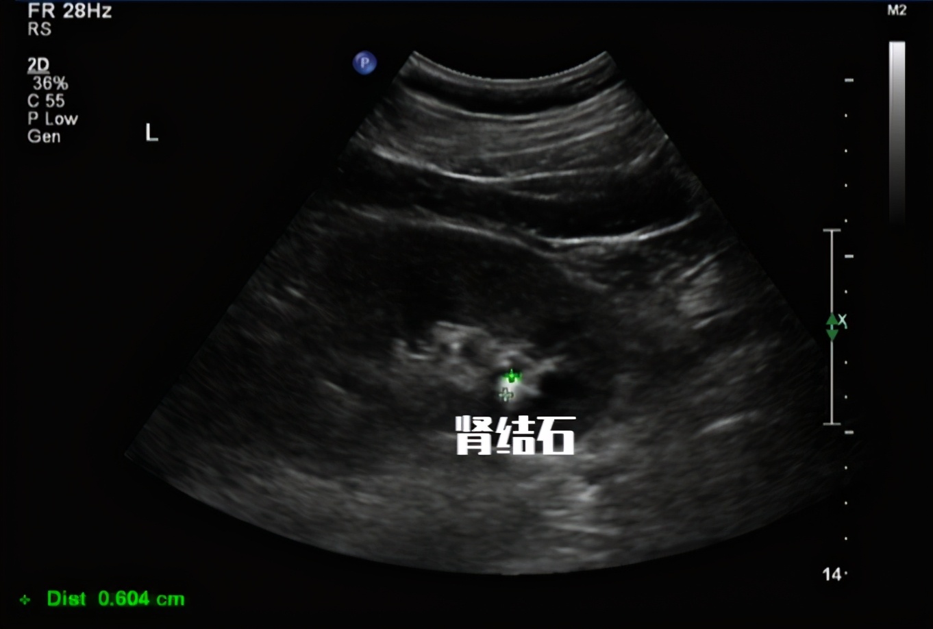 痛风痛在骨头上的症状,痛风导致肾疼要去医院吗