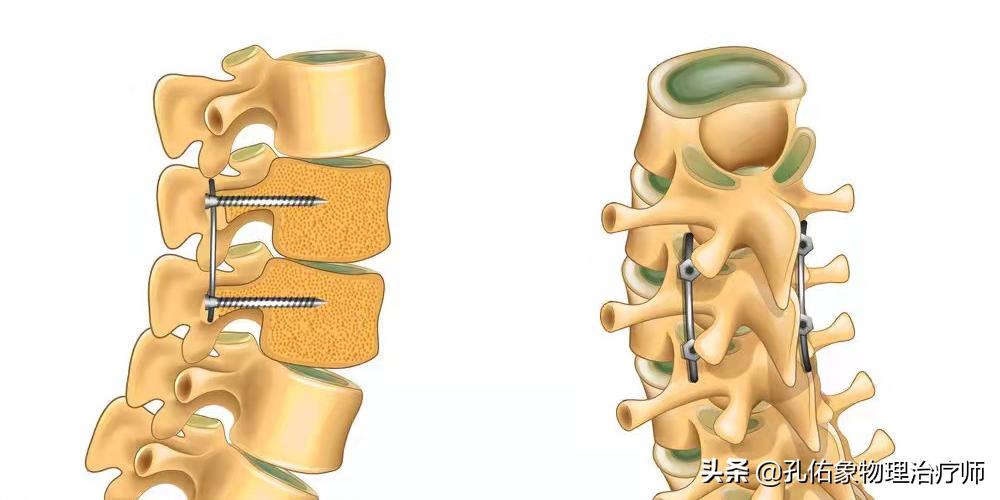 腰椎管狭窄引起的腰腿疼怎么办,腰椎管狭窄引起腰痛腿痛怎么办