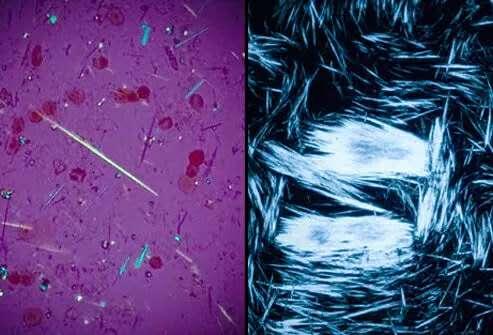 怎样知道痛风尿酸偏高,怎样知道有痛风结晶