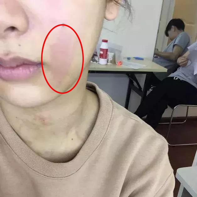 抗过敏祛红血丝,50岁过敏皮肤去红血丝最有效