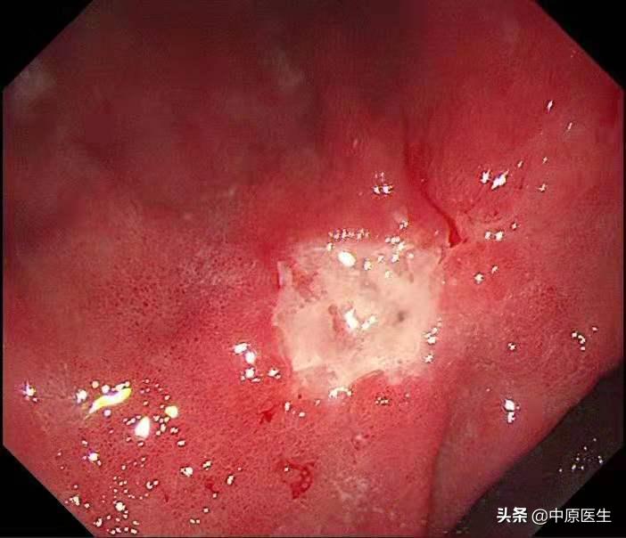 必须活检的胃溃疡:以为是胃溃疡,专家用另一方法放大发现是胃癌