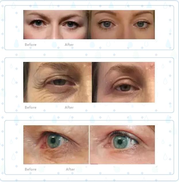 普丽普莱抗衰老,plexr电子医疗仪器