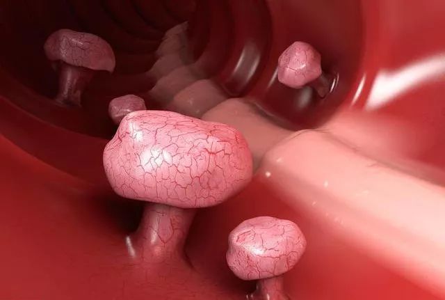 这种息肉，十有八九会癌变！医生呼吁：千万别小病拖成大病