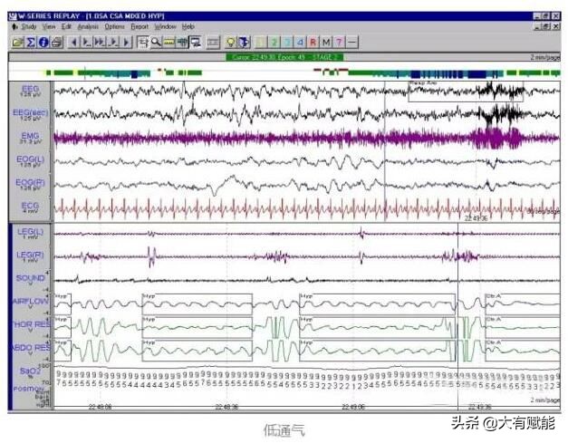 睡眠呼吸暂停监测全过程视频,深度解析呼吸暂停