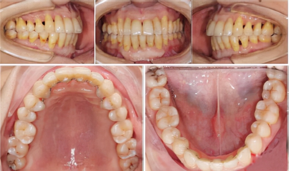 牙疼严重！糖尿病、心脏病接踵而来