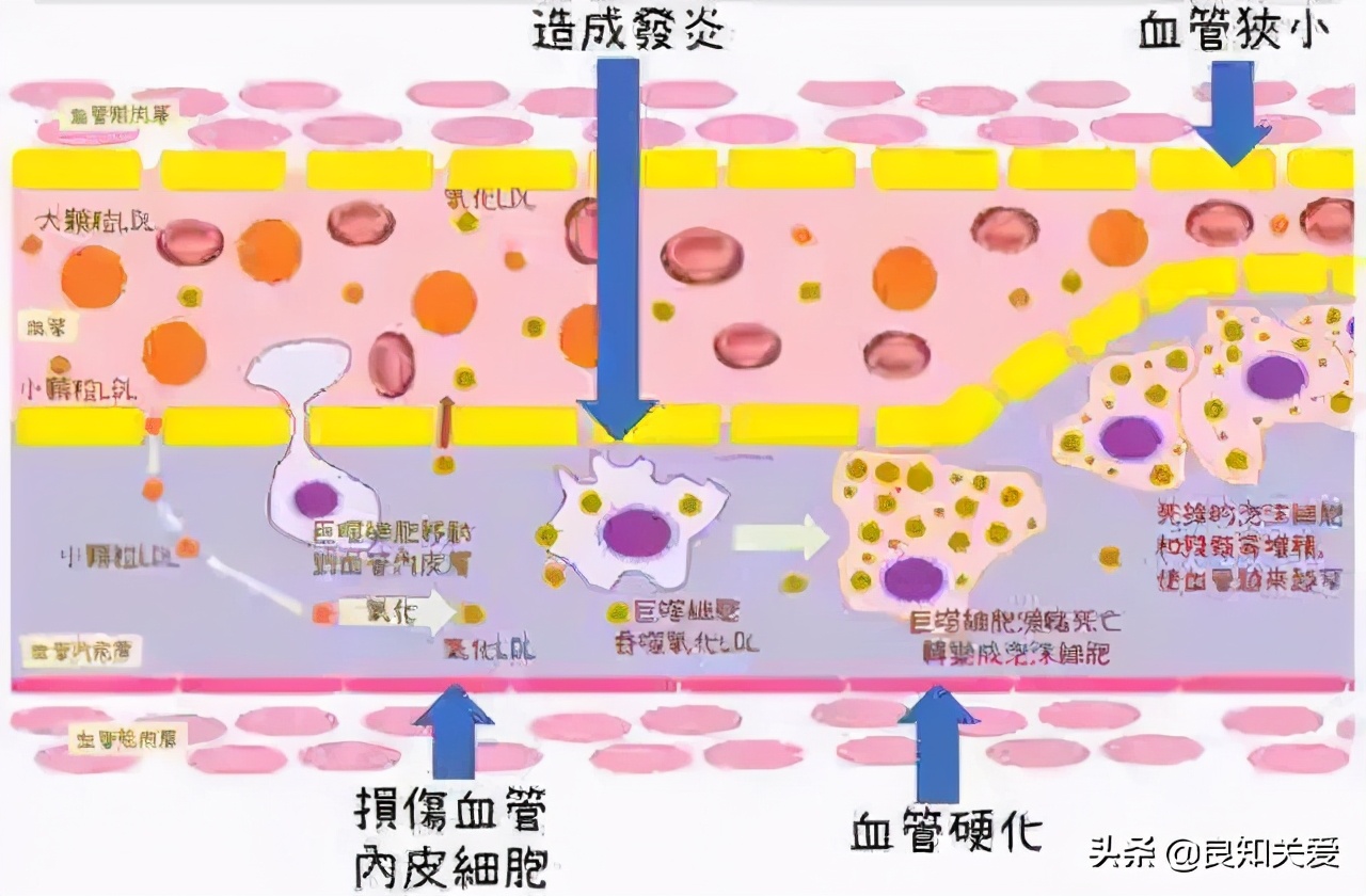 放支架后能打流感疫苗吗,支架术后可以打流感疫苗吗