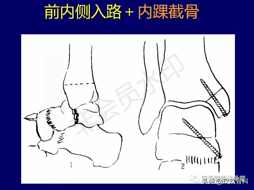 距骨骨折后遗症,距骨骨折怎么办