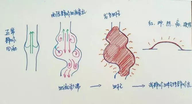 腿上的静脉曲张突然发青怎么回事,我静脉曲张脚总凉怎么办