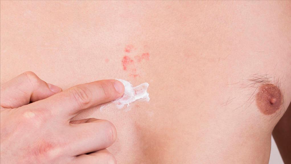 银屑病一直不好怎么办,银屑病中医治疗为啥反反复复