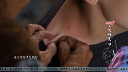 老人夏天发痧,痧气重怎么祛除吃什么好得快