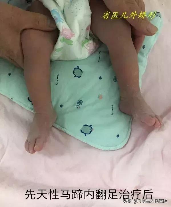 宝宝脚尖站立的原因,宝宝脚尖对脚尖走路怎么回事