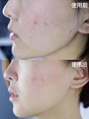 微整形美白针,微整形是永久的吗