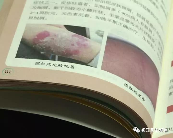 这种传染病进入发病高峰，名字有点吓人，还会交叉感染