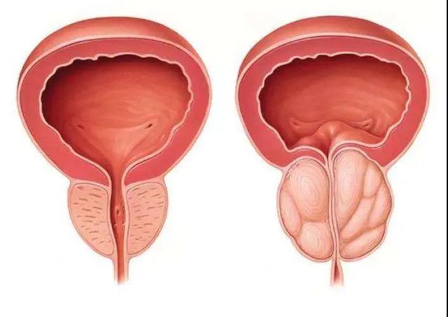 前列腺的生理功能是什么？前列腺为什么增生？
