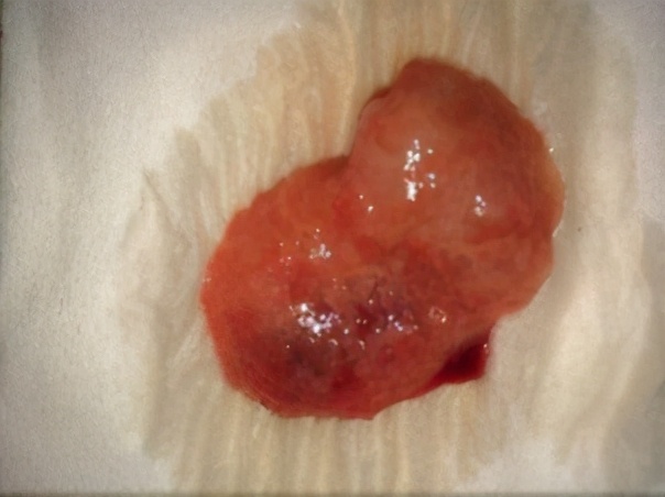 女护士意外怀孕二胎,医院护士意外怀孕