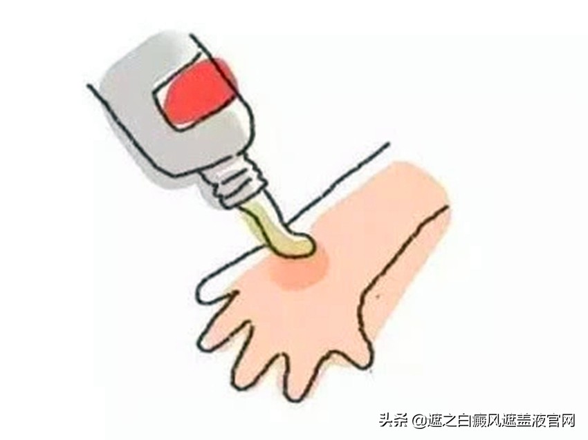 治疗白癜风时务必重视这几大事项,外用药治疗白癜风