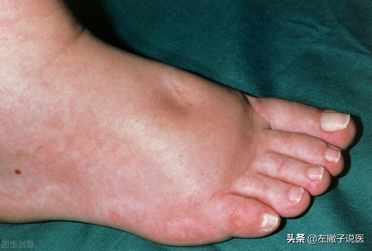 下肢水肿是心脏问题还是肾的问题,下肢水肿是湿气重吗