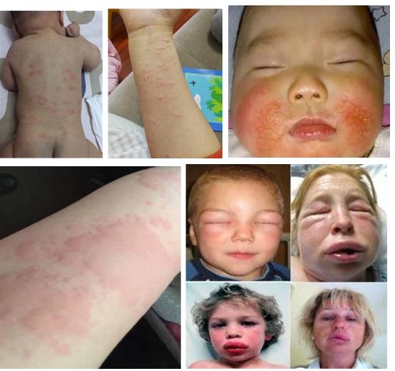 宝宝食物过敏红疹一般要多久好,如何发现宝宝对食物过敏了