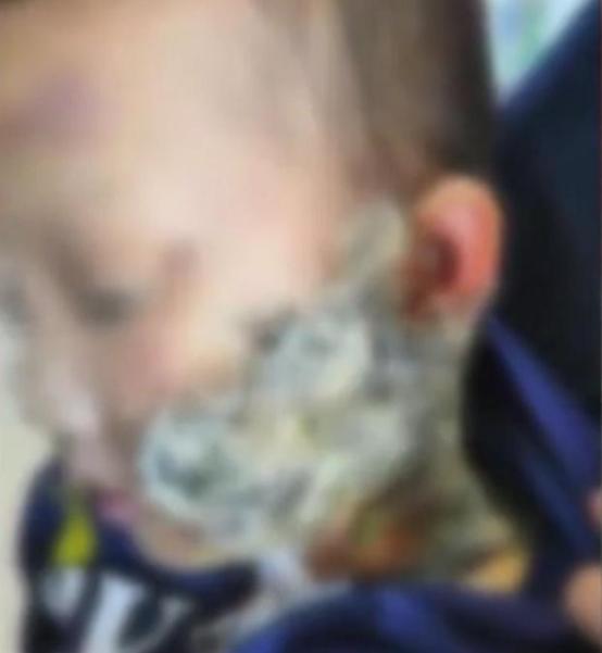 1岁男童脸烫伤,男童烫伤敷猫毛治疗