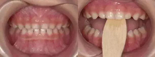 什么叫地包天怎么治疗,什么叫地包天能矫正吗