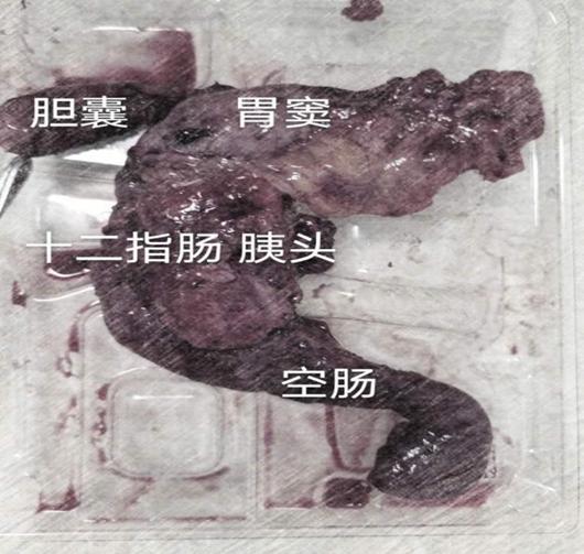 一位47岁胰腺癌患者的经验,胰腺癌晚期抗癌成功案例100例