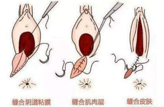 为什么很多顺产有侧切,为什么现在好多顺产的要侧切