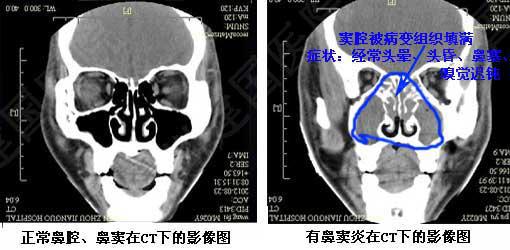 儿童鼻窦炎用药一般多久能好,儿童鼻窦炎和腺样体肥大药物