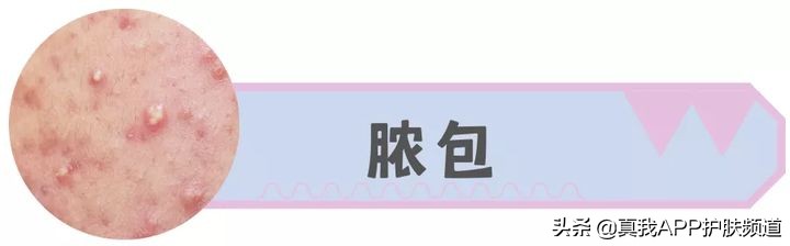 脸上长痘痘反反复复该怎么办,脸上一个部位反反复复长痘痘