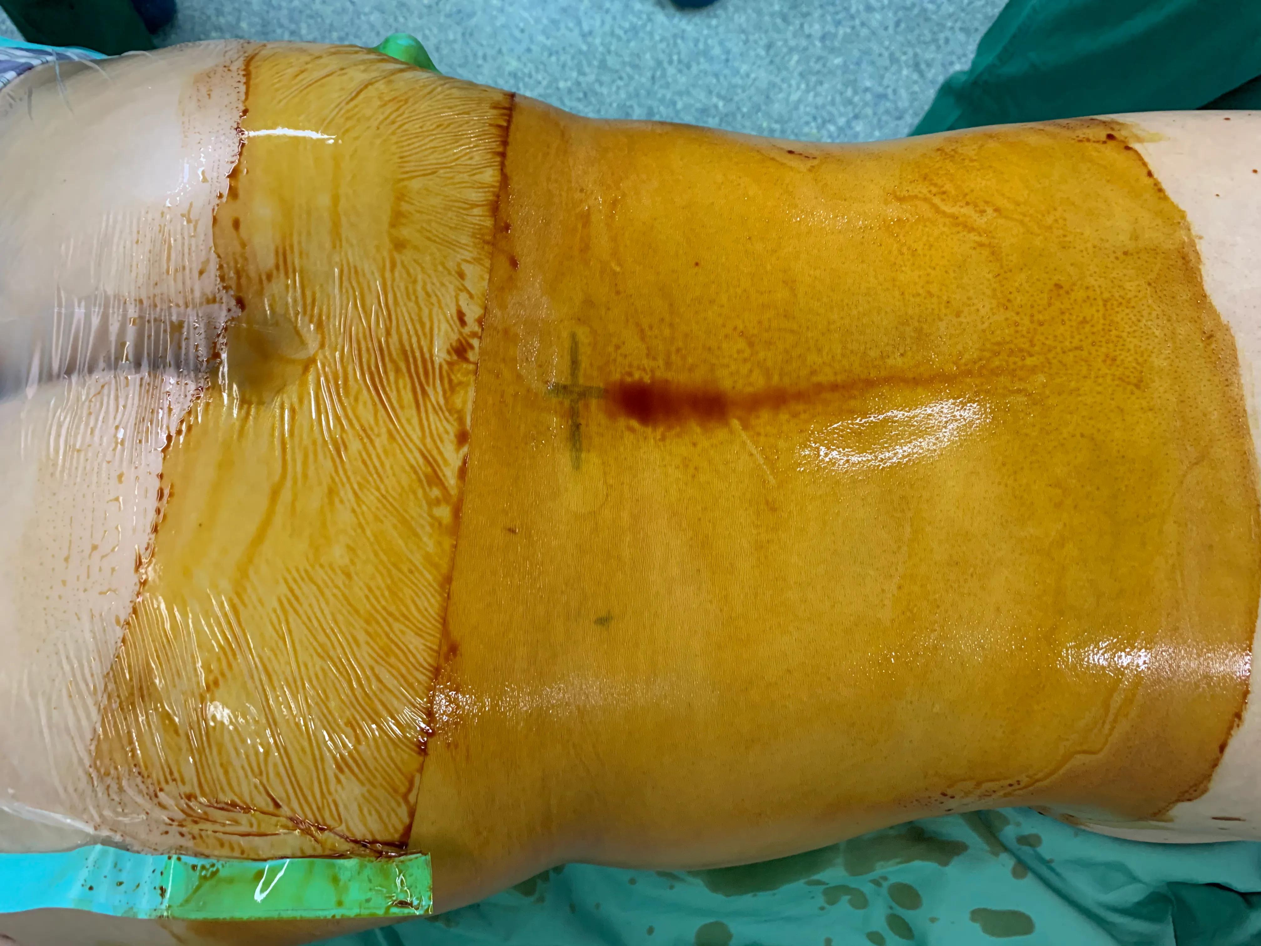 椎间孔镜术后腰痛症状多久消失,盘源性腰痛手术后易复发吗