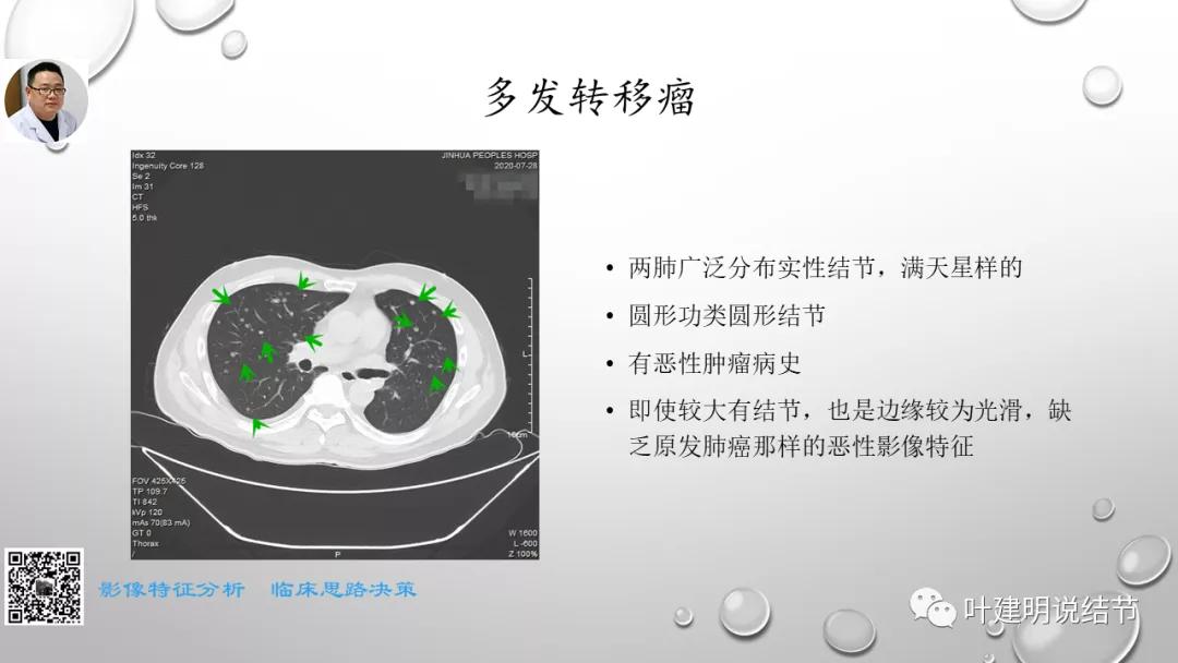 叶建明谈肺实性小结节视频,廖正银教授谈肺结节