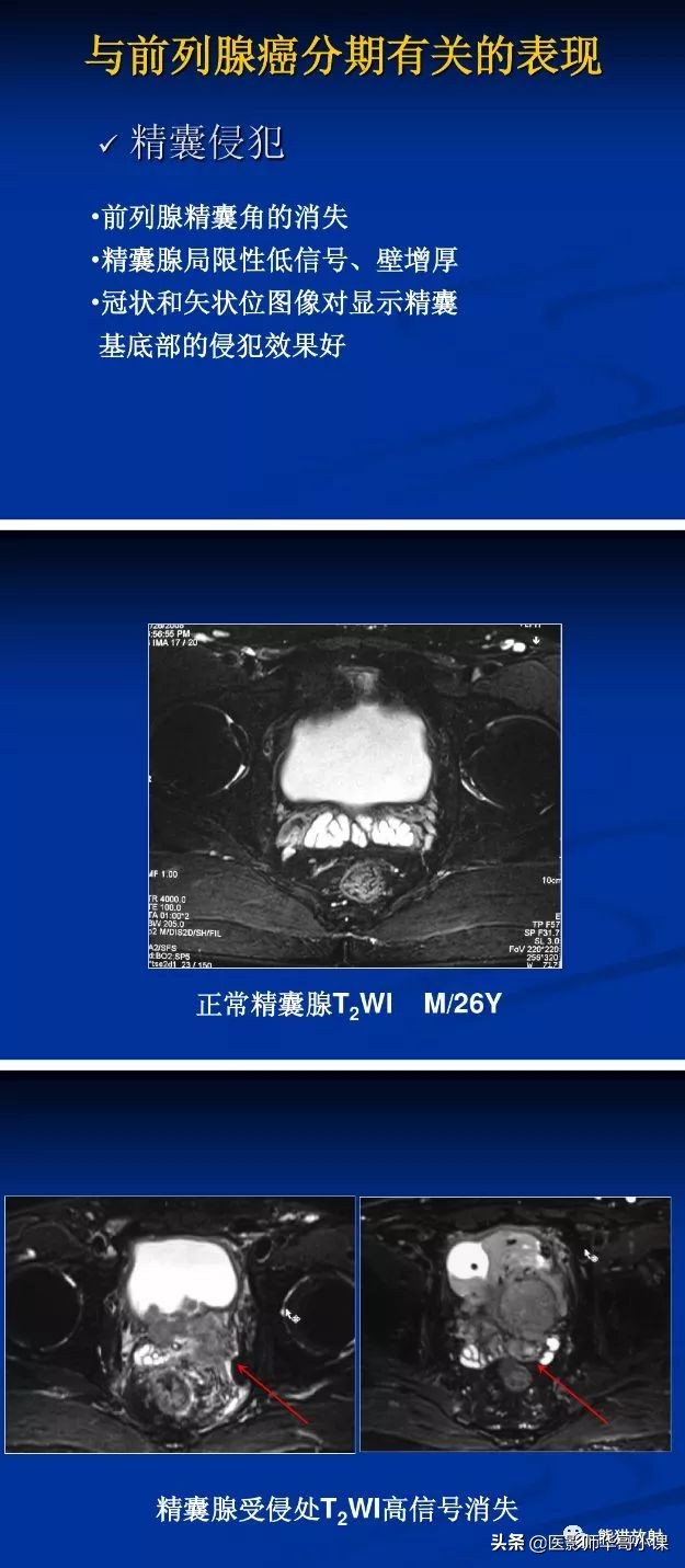 前列腺磁共振影像解剖,前列腺mri正常诊断报告模板