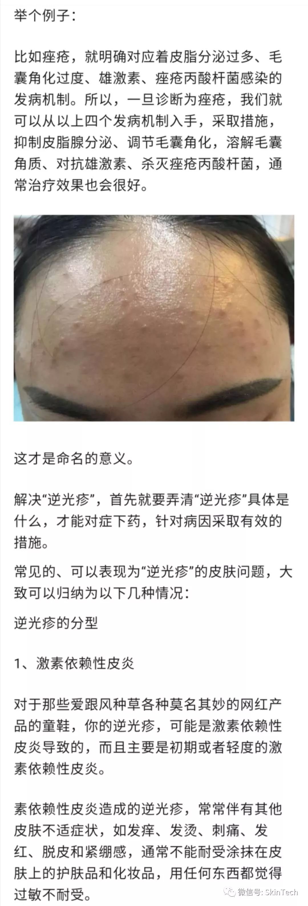 逆光疹是属于皮肤炎症吗,逆光疹是不是日光性皮炎