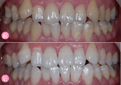 牙齿冷光美白，你了解多少？